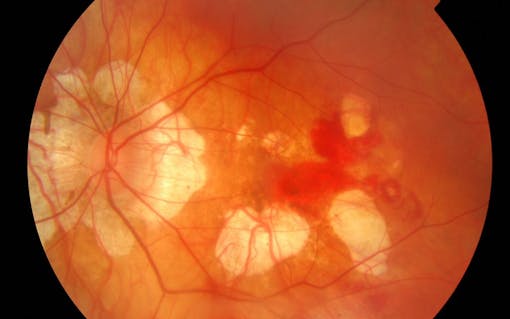 current treatments for glaucoma