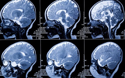 baby MRI Brain Scan:leukodystrophy illness and developmental anomaly