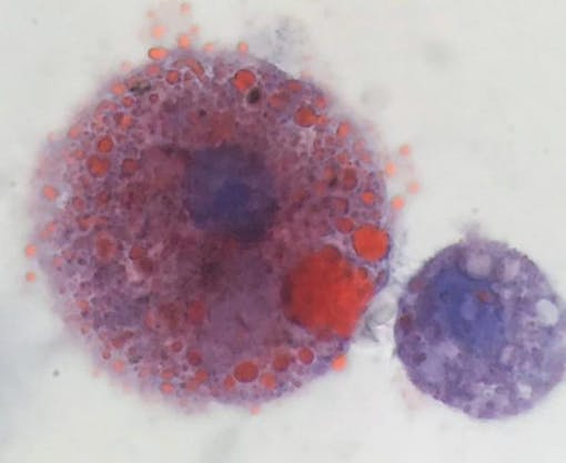 An oil-laden immune cell extracted from a VAPI patient in Utah (left). On the right, a normal macrophage. (Courtesy Andrew Hansen, Jordan Valley Medical Center)