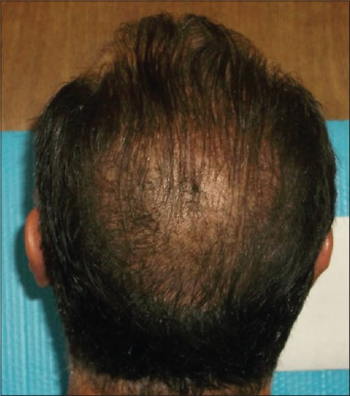 (Male alopecia sufferer after treatment with hemp extract)