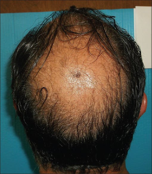 (Male alopecia sufferer before treatment)